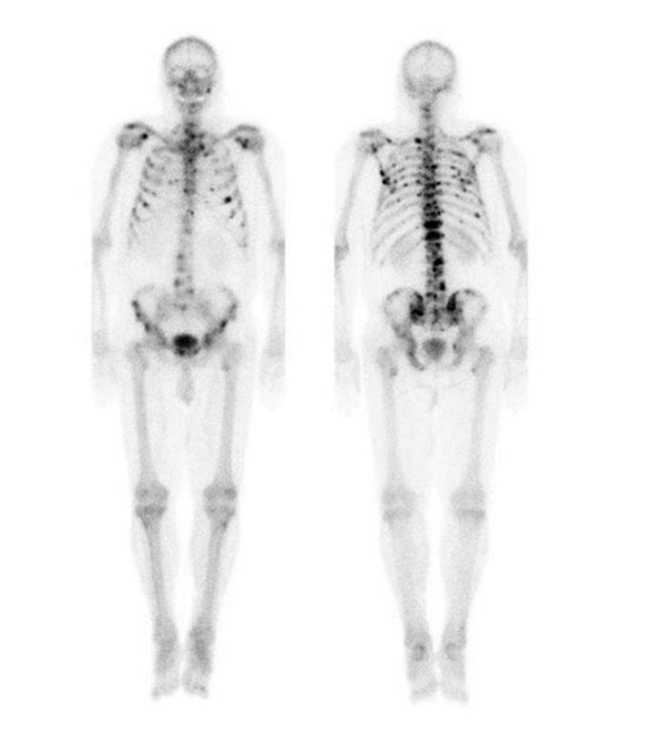 <ul><li><p>collected w/ CT data → images co-register together = more accurately localize site of uptake of injected radioactive tracer</p></li><li><p>radioactive tracer injected → taken up into targeted tissues</p><ul><li><p>emission of gamma rays detected</p></li><li><p>data reconstructed to form image</p></li></ul></li><li><p>advantage</p><ul><li><p>provides functional info, ex. nutrient + blood flow</p></li></ul></li><li><p>disadvantage</p><ul><li><p>difficult to determine exact anatomical location</p></li></ul></li></ul><p></p>