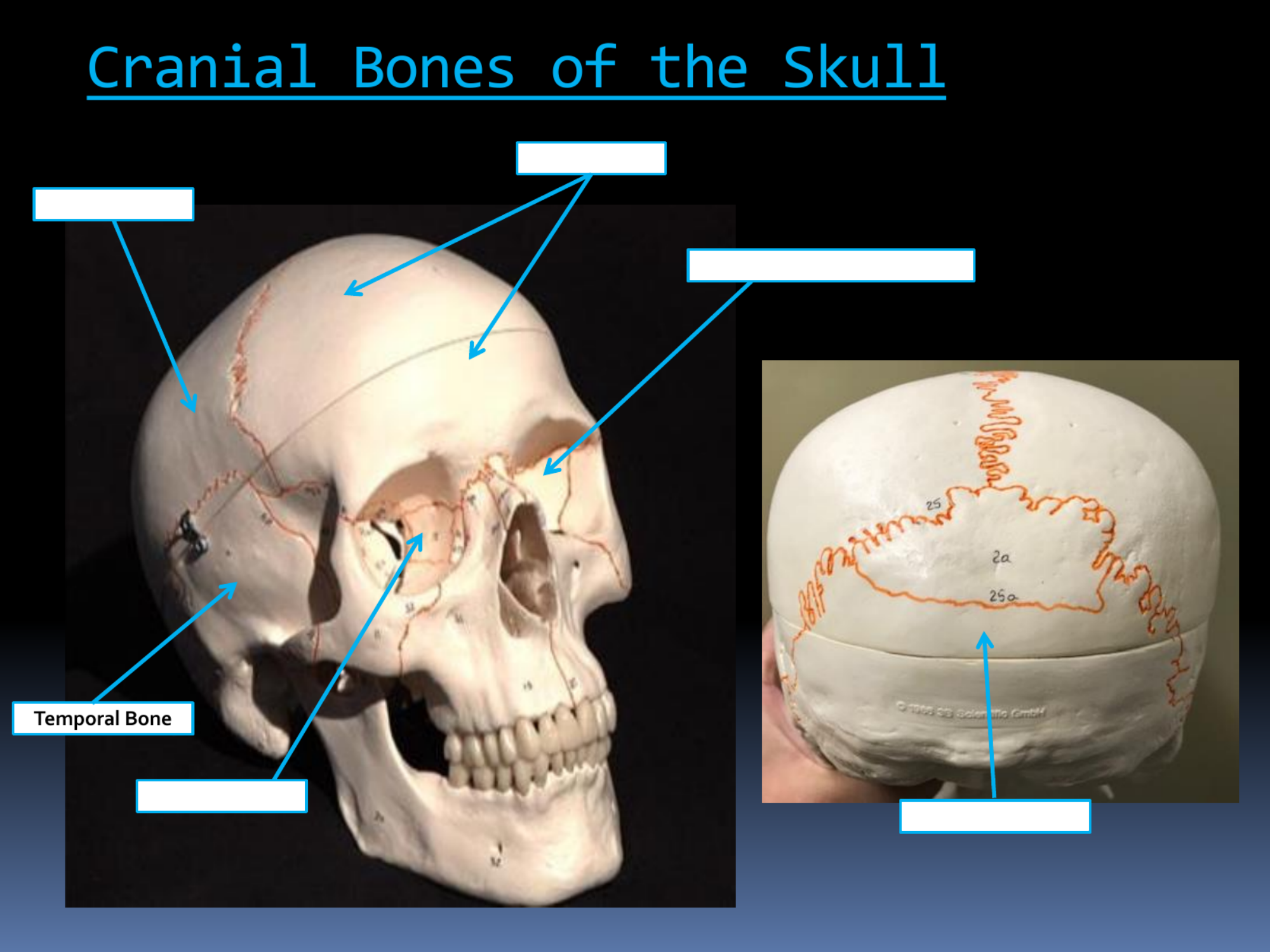<p>Temporal Bone</p>
