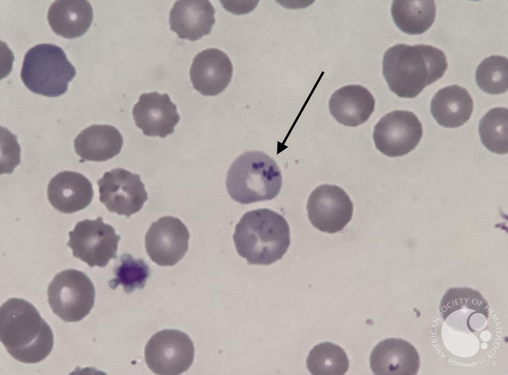 <p>What is this RBC inclusion?</p>