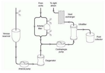 <p>Withdrawing blood from the patient through aortic cannula and passing it through hemoconcentrator and it goes back into the patient through venous cannula </p>