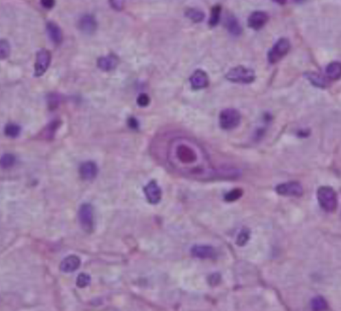 <p>What lymphocytotic pathogen causes this cell shape?</p>