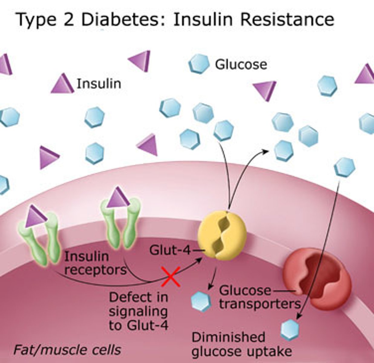 <p>Late-onset Diabetes</p><p>CAUSED BY: Reduced insulin production/ Insulin resistance</p><p>OCCURRENCE: Usually over 40, especially if OVERWEIGHT</p><p>RESULTS IN: Insulin not being produced or produced but not used effectively</p><p>TREATMENTS: Diet Control, Exercise, Medication</p>