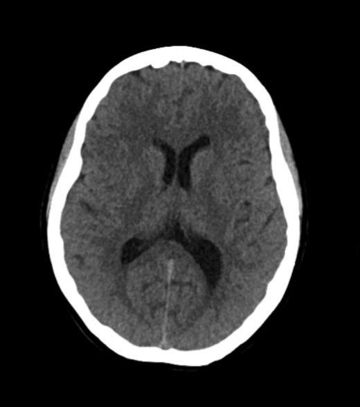 <p>-great resolution</p><p>-bone signal very strong, soft tissue weaker with poor contrast between soft tissue types (unless contrast agent used eg in blood)</p><p>-usually gray scale</p>