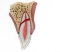 <p>What is a root fracture?</p>