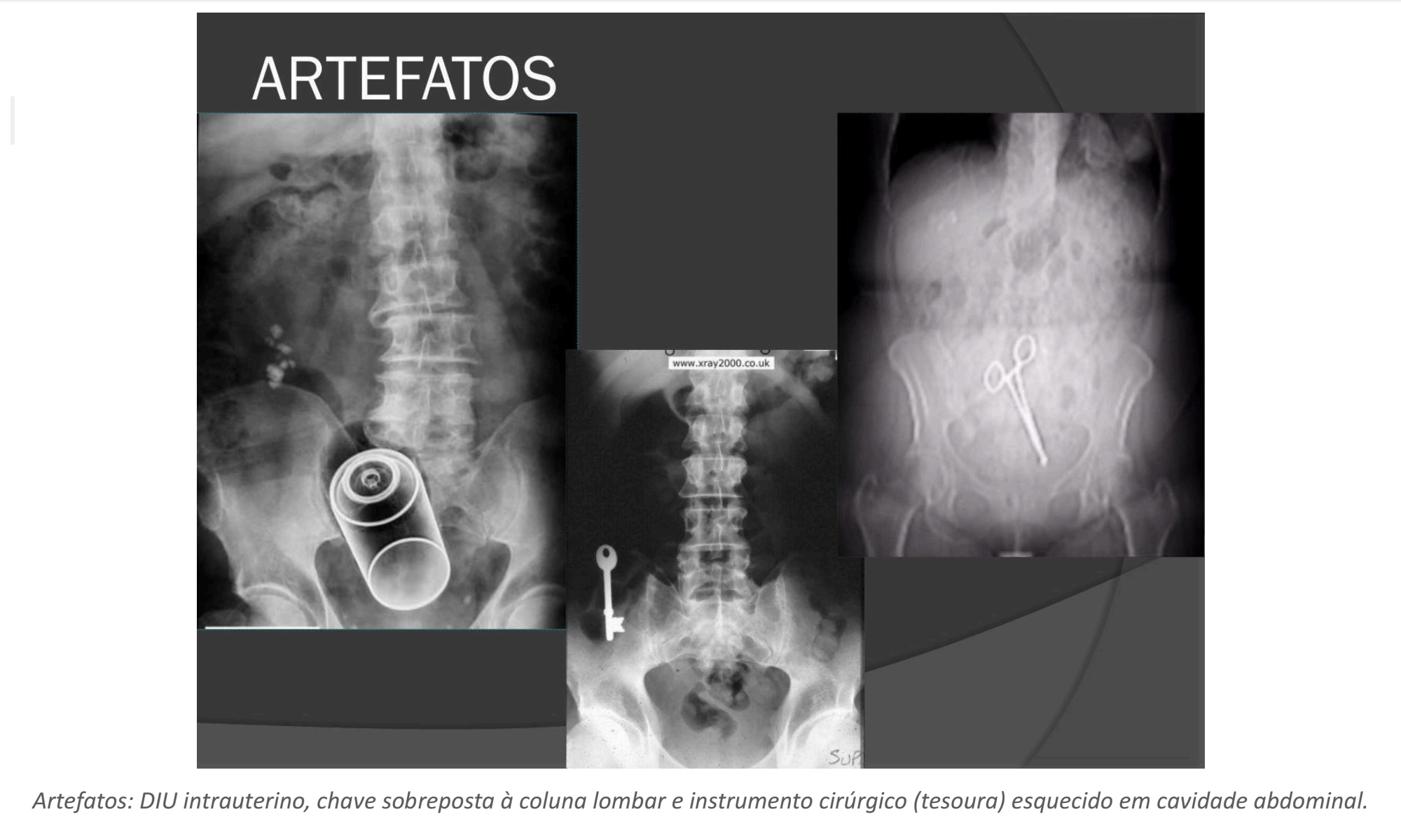 <p>Quais são exemplos de artefatos por corpos estranhos/objetos?</p>