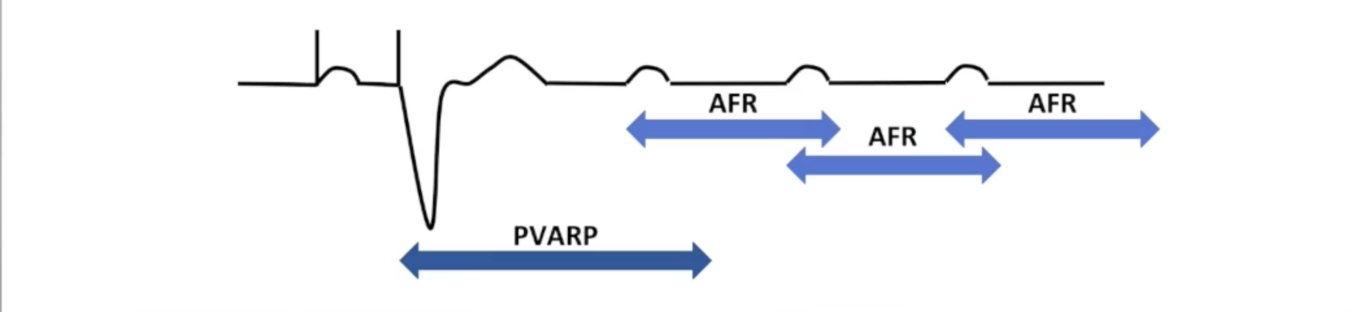 <ul><li><p>Separately programmable atrial flutter response rate</p></li><li><p>Triggers flutter response window: atrial refractory period</p></li><li><p>Atrial event within window triggers new window</p></li><li><p>Continues until mode switch criteria met or rate slows</p></li></ul><p></p>
