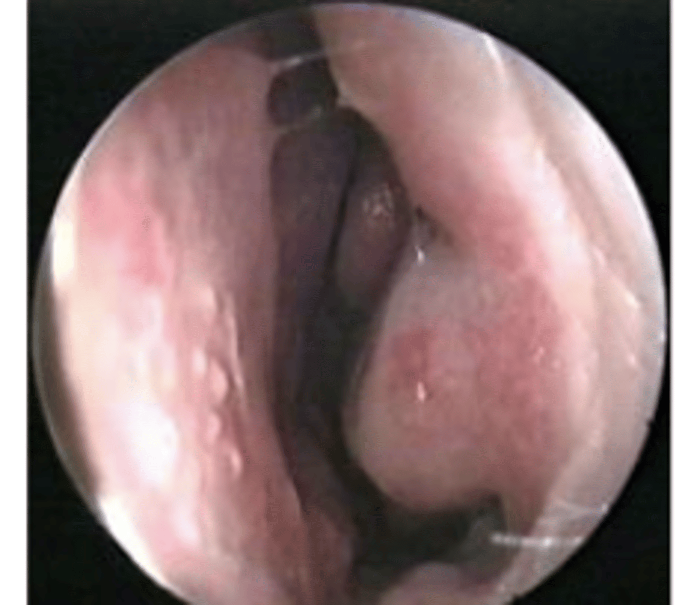 <p>pale nasal mucosa</p><p>an allergic reaction to airborne allergens that causes an increased flow of mucus</p>