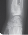 <p>A break in the distal portion of the radius, typically from cushioning a fall.</p>
