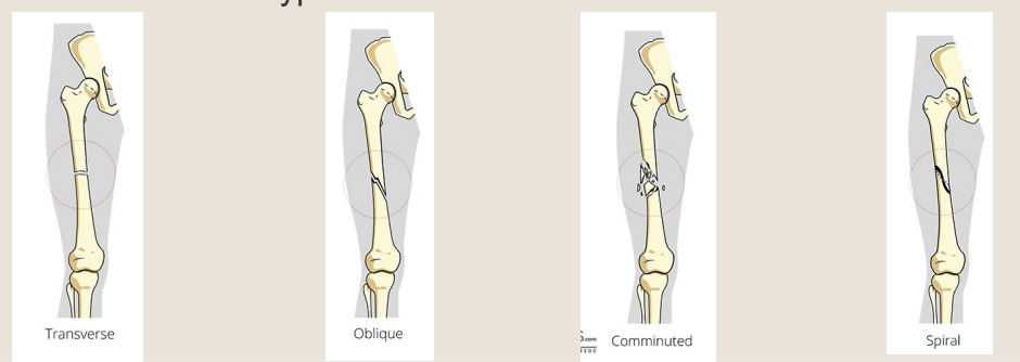 <p>name each type of shape fragments of <strong>complete</strong> fractures</p>