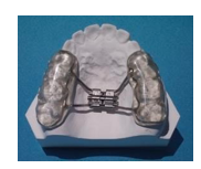 <p>which type of palatal expander:</p><p>◦ Full acrylic coverage of posterior teeth</p><p>◦ Can split the midpalatal suture</p><p>◦ True boney expansion</p><p>◦ Less dental tipping due to full dental coverage</p><p>◦ Difficulty with oral hygiene</p><p>◦ Risk of extracting primary teeth on removal</p><p>◦ Good for open bite patients</p>