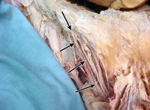 <p>what nerve is being indicated to in the image? (context: image is taken of spermatic cord)</p>