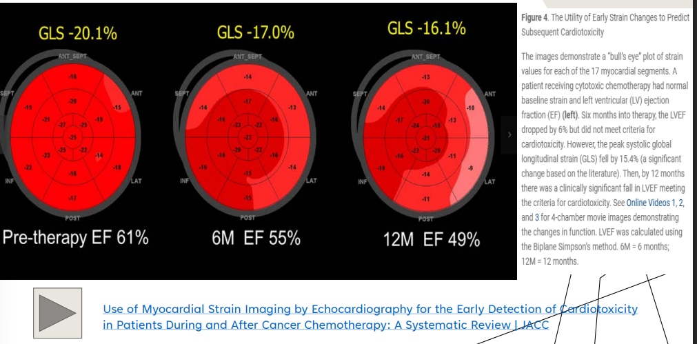 <p>Some chemotherapeutic drugs may be cardiotoxic</p><p>May occur during or even years after treatment</p><p>Follow up every 3 months if cardiotoxic agent is utilized (STRAIN)</p><p>(LV strain - predicts LV function and EF and important to check)</p><p>In DCM, cardiotoxic injury can weaken the myocardium so the ventricle dilates and systolic function decreases.</p><p>Simple definition:</p><figure data-type="blockquoteFigure"><div><blockquote><p>Cardiotoxic = harmful to the heart muscle or heart function.</p></blockquote><figcaption></figcaption></div></figure><p></p>
