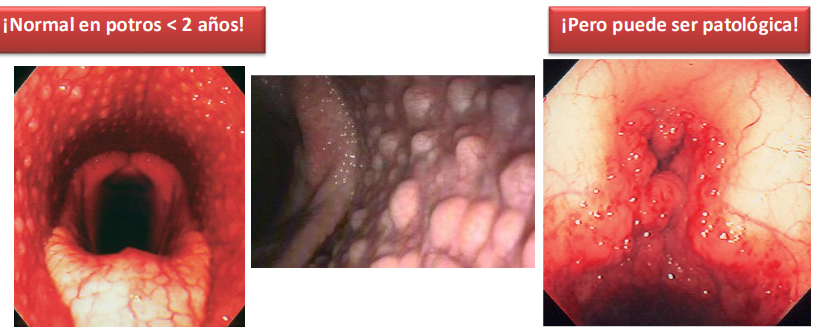 <p>hiperplasia linfoide faríngea</p><ul><li><p>inflamación y proliferación de tejido linfoide nasofaríngeo</p></li><li><p>normalillo en postros d menos d dos años</p></li></ul><p>osea son como noduillos linfoides fisiologicos, un monton de puntitos q es tejido granulomatoso en la faringe, pero exceso de crecimiento provoca obstruccion entonces es patologico</p><p></p>