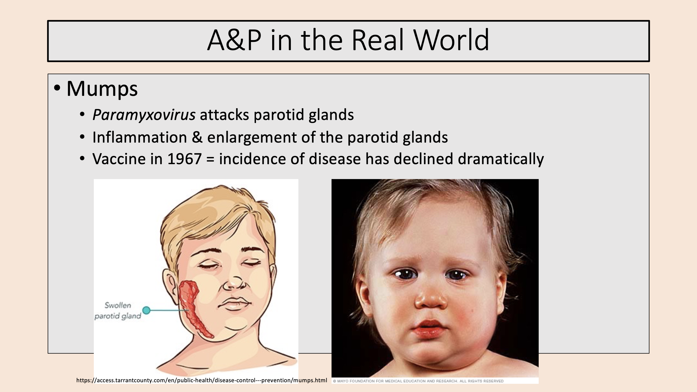 <p><span>mumps</span></p>