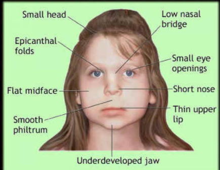 <p><span style="color: rgb(247, 247, 247);">1. Short palpebral<br>fissure<br>2. Smooth philtrum<br>3. Short upper lip<br>Problem: Only ~10% of<br>those with FASD have<br>sentinel facial features</span></p><p><span style="color: rgb(247, 247, 247);"><br></span></p>
