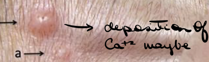 <p>What primary lesion is this? (<1 cm)</p>