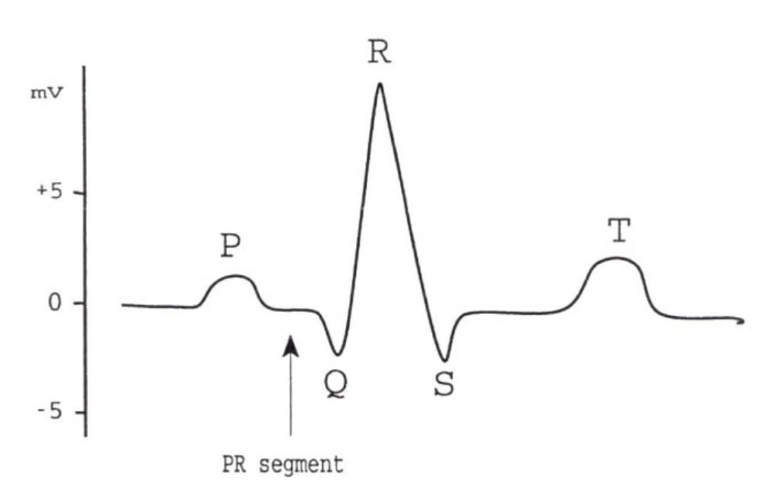 <ul><li><p><span style="color: rgb(0, 0, 0);"><strong>P wave</strong>: time of depolarization of the atria. An abnormal shape of the P<br>wave might indicate abnormal atrial function.</span></p></li><li><p><span style="color: rgb(0, 0, 0);"><strong>P-R segment</strong>: AV delay, impulse travels over bundle of His and Purkinje fibers. A longer segment might indicate malfunction of the AV node or bundle of His. If the P-R segment is abnormally long, the impulse will probably not pass properly onto the ventricles. This is called a first-degree heart block.</span></p></li><li><p><span style="color: rgb(0, 0, 0);"><strong>QRS</strong>: This interval coincides with the depolarization and contraction of the ventricles. If a P wave is not followed by a QRS wave, and only some impulses from the SA node activate the AV node, this is a second degree heart block. If there is no relation between the P and QRS wave, this is called a third degree heart block.</span></p></li><li><p><span style="color: rgb(0, 0, 0);"><strong>ST segment and T- wave</strong>: These coincide with the repolarization of the ventricle</span></p></li></ul><p></p>