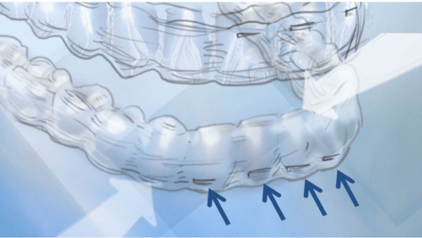 <p>ID feature of aligner:</p>