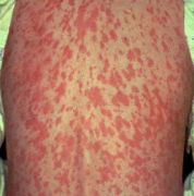 <p>rubeola (measles) cause, prodrome, sx*</p>