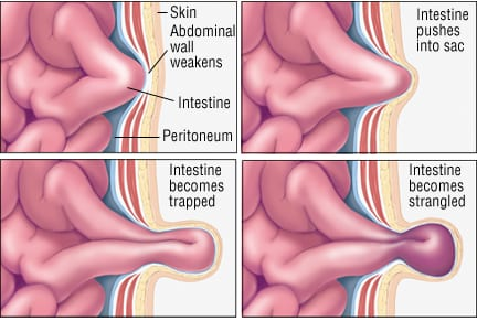 <p>hernia - <u>abnormal protrusion</u> of structure out of normal anatomical position</p>