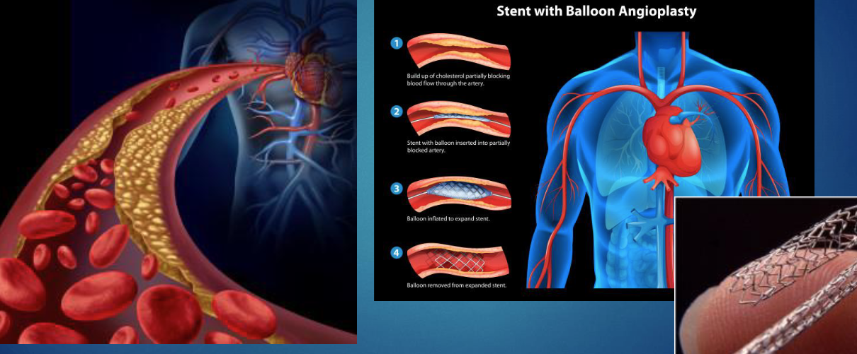 <p>when a balloon tipped catherter is inserted in artery</p><ul><li><p>balloon is inflated to flatten plaque &amp; expand artery</p></li><li><p>mesh tube/stent is placed to keep artery open</p></li></ul><p></p>