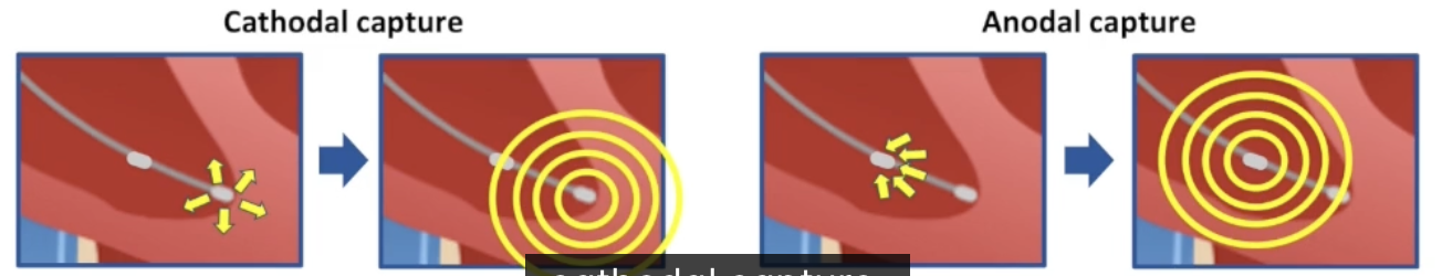 <ul><li><p>Depolarization caused by electrons returning to positively charged anode</p></li><li><p>Higher threshold than cathodal capture</p></li><li><p>RV leads:</p><ul><li><p>Anode has larger surface area: anodal capture less likely</p></li><li><p>Close spacing of anode and cathode: anodal capture less significant</p></li></ul></li></ul><p></p>