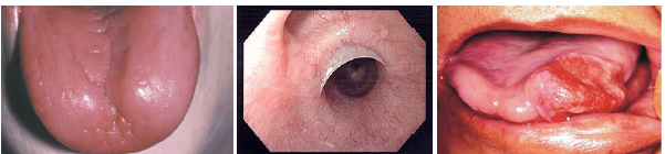 <p>•Tongue smooth shiny and erythematous surface</p><p>•Burning sensation of tongue commonly reported</p><p>•Dysphagia due to esophageal web formation</p><p>•Oral mucosa may appear pale clinically</p><p>•Increased cancer risk in oral tissues present</p>