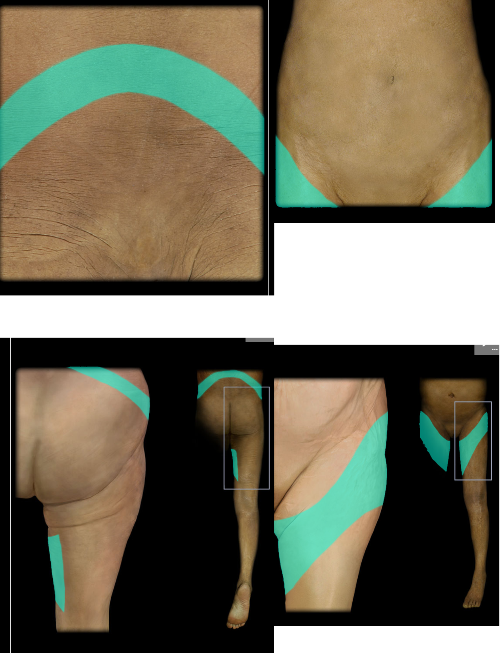 <p>L2 Dermatome</p>