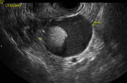 <p><span>What ultrasound feature do we see with dermoids?</span></p>