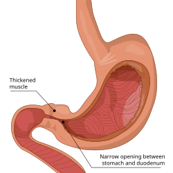 <p>pyloric stenosis</p>