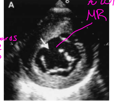 <p>A cleft of the anterior mitral valve leaflet is present, and the opening is directed toward the <strong>ventricular septum</strong>.</p>