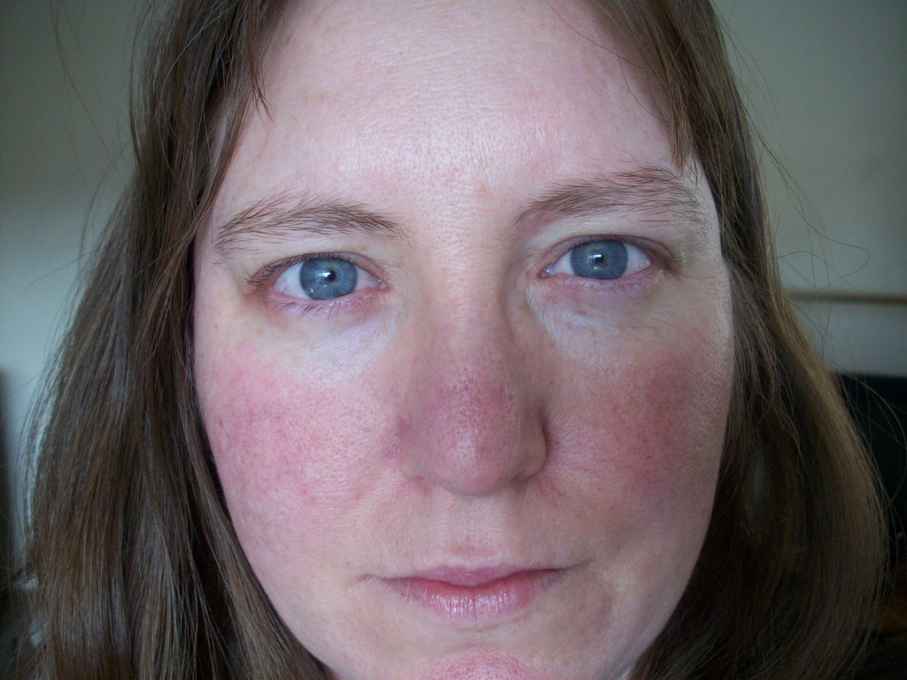 <p>What is rosacea?</p>