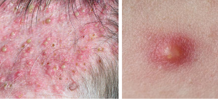 <ul><li><p><strong>primary lesion</strong></p></li><li><p>raised, smooth, soft, pale yellow to green (pus), red periphery</p></li><li><p>ex. bacterial infection (very common), pemphigus foliaceus (rare)</p></li></ul><p></p>