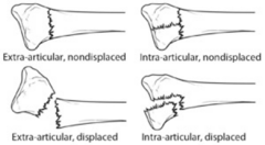 <p>fx within or involving a joint</p>