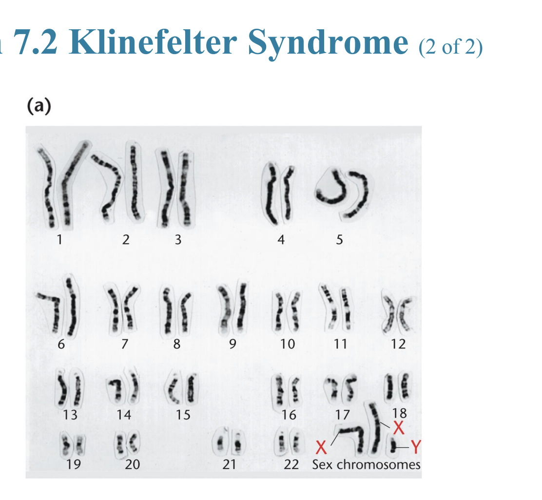<ul><li><p>Klinefelter syndrome (47,XXY)</p></li></ul><p></p>