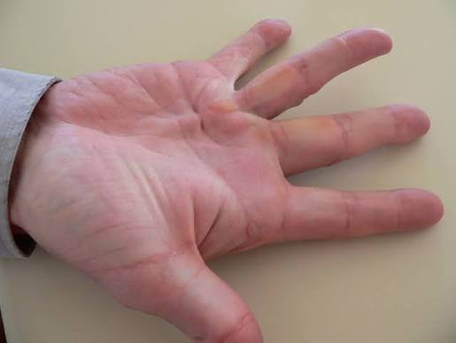 <p>Dupuytren’s contracture</p>