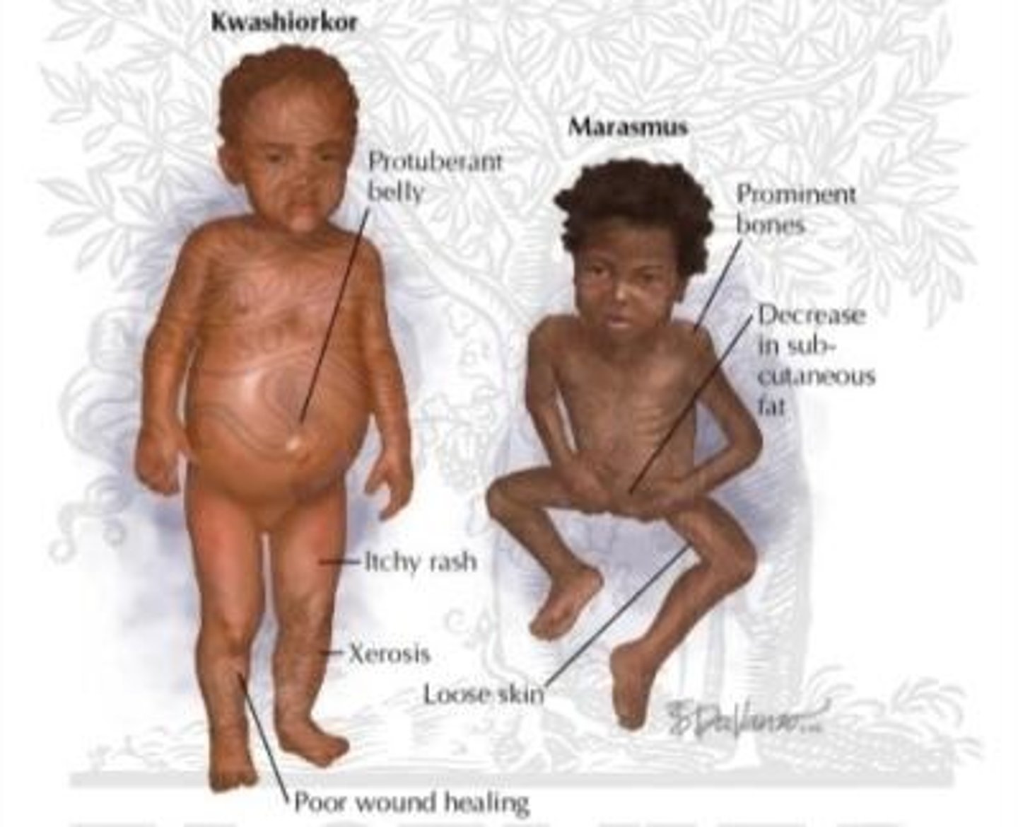 <p>Deficiency of all nutrients; causes severe wasting, no edema, and loose skin.</p>