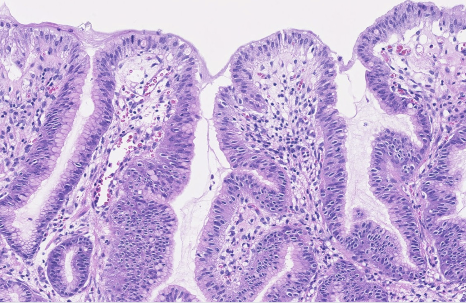 <p>Lésion polypoïde estomac </p><p>1) diagnostic</p><p>2) différence avec dysplasie</p><p>3) types histologiques + différences majeures </p><p>4) moléculaire </p>
