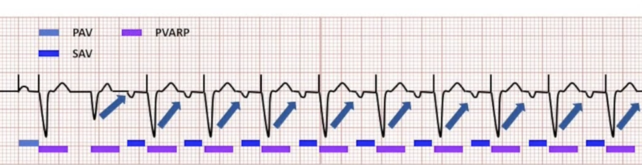 <ul><li><p>Requirements for initiation:</p><ul><li><p>Dual chamber tracking mode</p></li><li><p>Ability to conduct retrograde</p></li><li><p>Longer VA conduction time than PVARP</p></li><li><p>Triggering event causing loss of AV synchrony</p></li></ul></li></ul><ul><li><p>VA conduction:</p><ul><li><p>80% of patients with SSS</p></li><li><p>35% of patients with AV block</p></li></ul></li><li><p>20% of patients with VA conduction have experienced PMT</p></li></ul><p></p>