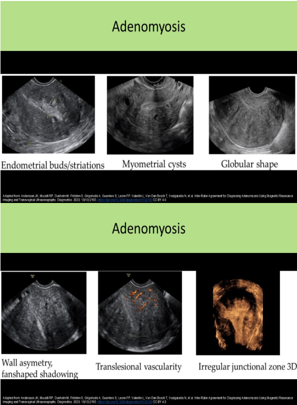 <p>C. adenomyosis</p><p>Adenomyosis refers to the abnormal location of endometrial tissue in the myometrium.</p><p>Sonographic Findings:</p><p>Thickened, heterogeneous myometrium</p><p>Subendometrial echogenic nodules</p><p>Small myometrial cysts / subendometrial cysts (<6mm)</p><p>"Swiss cheese" appearance of muscle</p><p>Striated vertical edge shadows/"venetian blind" shadowing without a discrete mass</p><p>Enlarged globular uterus with smooth contour</p>