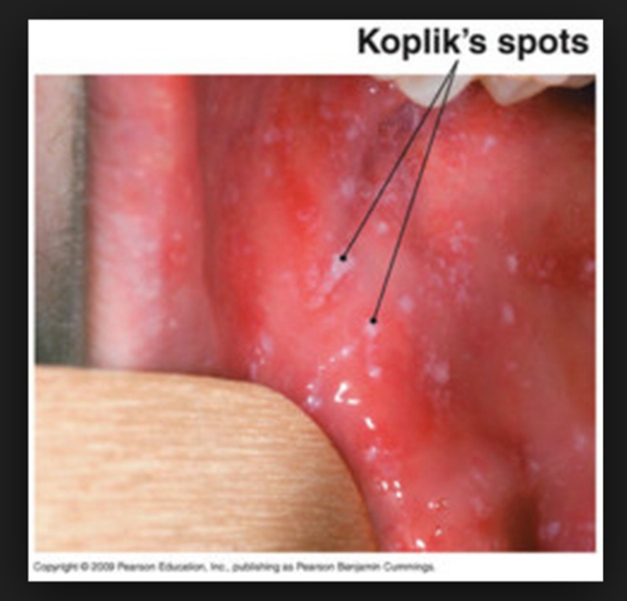 <p>AKA rubeola</p><p>- koplick's spots (in mouth)</p><p>- dry cough/fever/runny nose/pink eye</p><p>-blotchy macular rash on face</p>