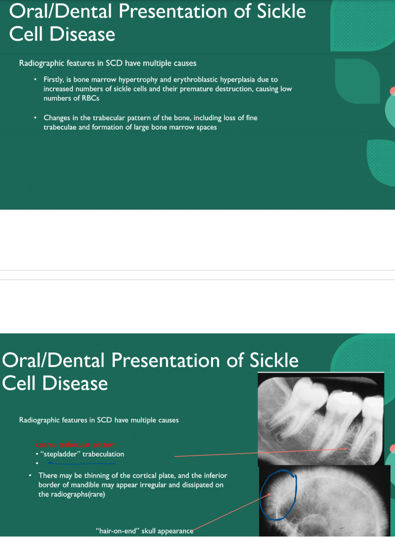 <p>Hair-on-end pattern </p>