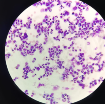 <p>Bone Marrow - Wright-Giemsa</p><ul><li><p>reticular connective tissue</p></li><li><p>built of collagen type 3 fibers</p></li><li><p>inside the bone marrow - formation of several blood lineages</p></li><li><p>most likely to observe the stages of erythropoiesis (basophilic, erythroblast, polychromotophic, etc)</p></li><li><p>observe stages of granulopoiesis </p></li><li><p>very big cells (megakaryocytes) which produce platelets</p></li></ul><p></p>