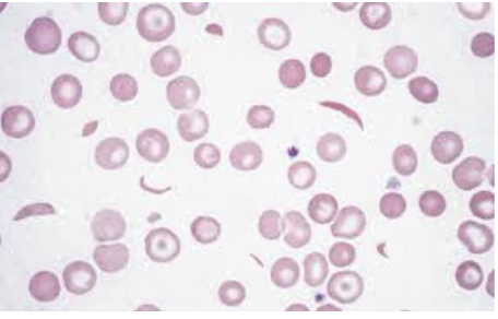 <ol><li><p>Sickle Cell Anemia</p></li><li><p>Atherosclerosis</p></li><li><p>Adenocarcinoma of Kidney</p></li><li><p>Osteogenic Sarcoma of Bone</p></li><li><p>Tattoo in Human Skin</p></li><li><p>Neurilemmoma</p></li><li><p>Anthracosis of the Lung</p></li><li><p>Basal Cell Carcinoma</p></li><li><p>Lung</p></li><li><p>Skeletal</p></li><li><p>Kidney</p></li><li><p>Neuron</p></li><li><p>Skin</p></li><li><p>Blood</p></li><li><p>Bone</p></li><li><p>Aorta</p></li></ol><p></p>