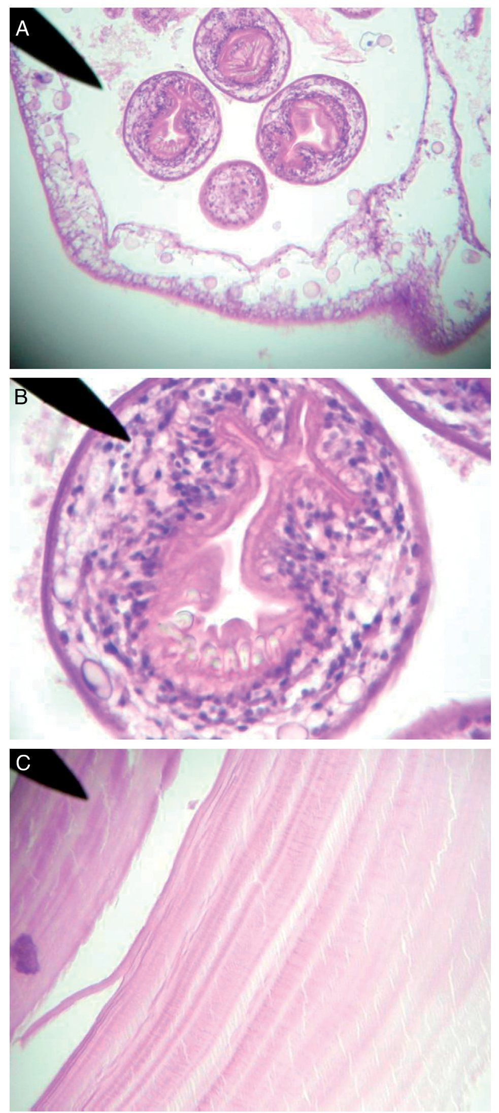 <p>Hydatid brood capsule with protoscolices</p><p>‘Hydatid sand’<br>Refractile hooklets</p>
