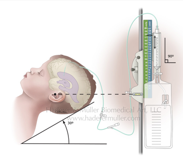 <p>MEAN - ICP = CPP</p><p>Door de ICP te meten in combinatie met de gemiddelde arteriële bloeddruk (mean) krijg je een indruk van de cerebrale bloedvoorziening = cerebrale perfusiedruk.</p><p>De houding van het kind in bed is medebepalend voor een zo laag mogelijk ICP. Het kind moet verpleegd worden in rugligging met het hoofd en de nek in de middenpositie ten opzichte van de romp en met het bovenlichaam in 30° anti-trendelenburg.</p>