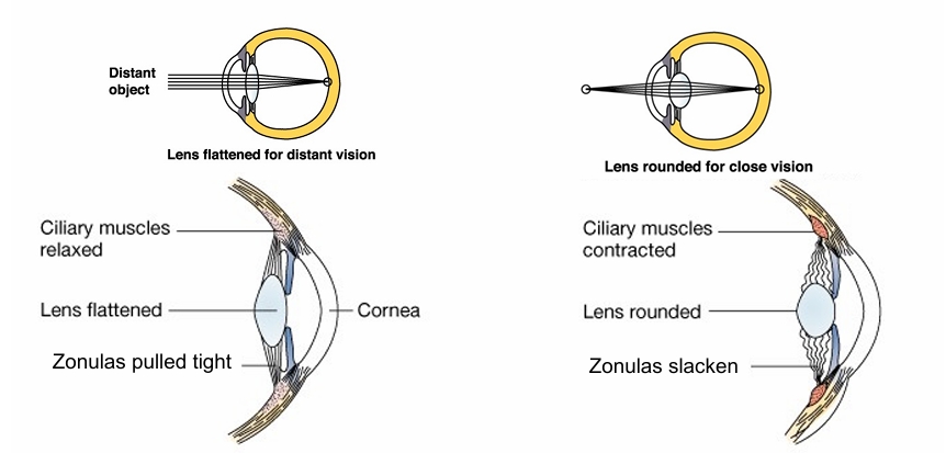 <p>• Lens flattened for distant vision, rounded for near vision (below), </p><p>• Contraction of ciliary muscles allows zonulas of Zinn to slacken, lens expands and becomes more rounded.</p><p>• Accommodation weakens with age. Reading glasses needed in middle age</p>