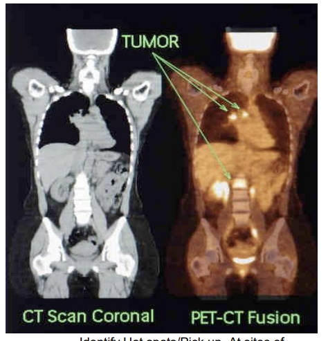 <ul><li><p>provides the detail of disorder and function information (PET)</p></li><li><p>and detailed image of anatomy (CT)</p></li></ul><p><span>PET and CT are <strong>two completely different imaging systems</strong> built into <strong>one scanner</strong>, but they collect <strong>different types of information</strong>:</span></p><ul><li><p><span><strong>CT</strong> → anatomy (structure)</span></p></li><li><p><span><strong>PET</strong> → physiology (function/metabolism)</span></p></li></ul><p><span>Because they are acquired in the same session, the computer can align (<strong>co‑register/fusion</strong>) the PET and CT images so they fuse into one image </span></p><p></p>