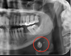 <p>What is the location of this lesion?</p>