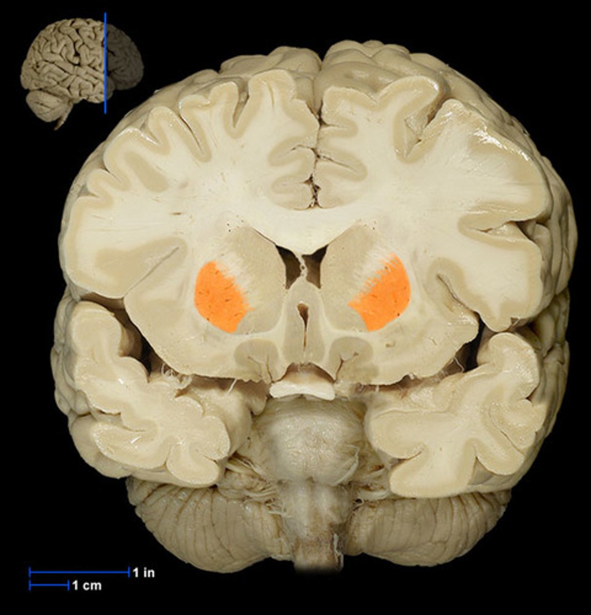 <p>Part of basal nuclei</p>